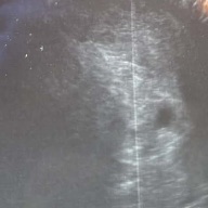 Claudia’s first pregnancy scan